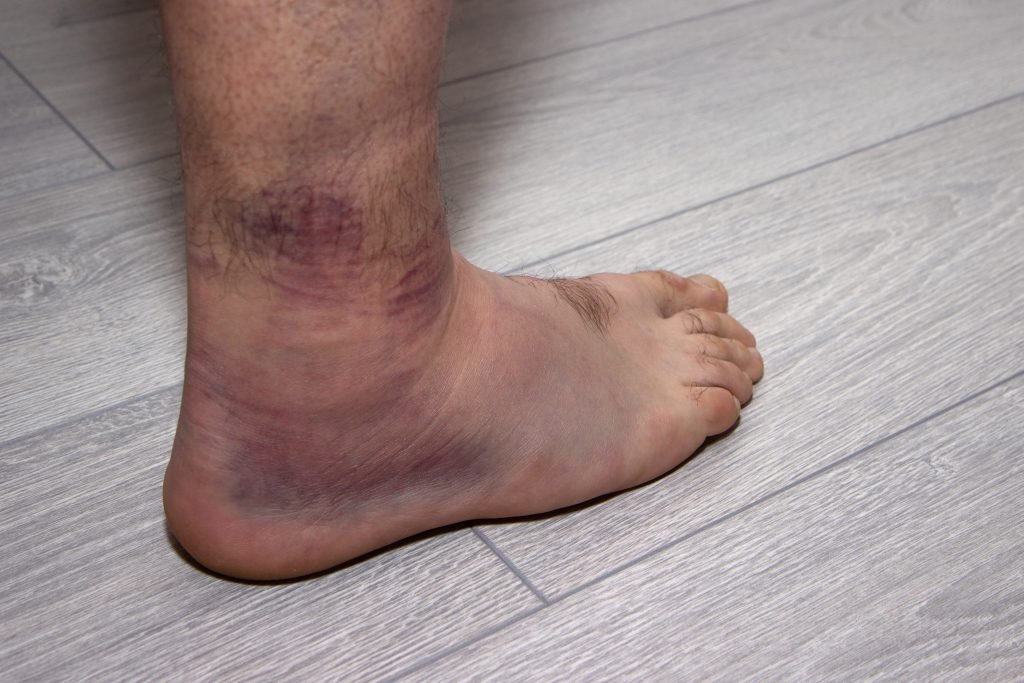 Ankle Sprain