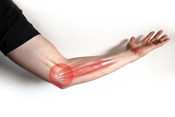 Golfer's Elbow