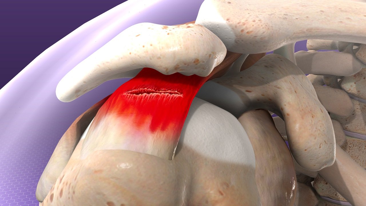 Rotator Cuff Injuries